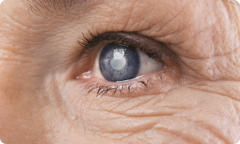 eye with cataract - Dry Eye Conditions